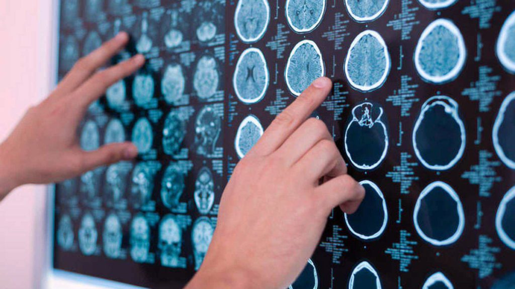 Toronto Traumatic Brain Injury Lawyers